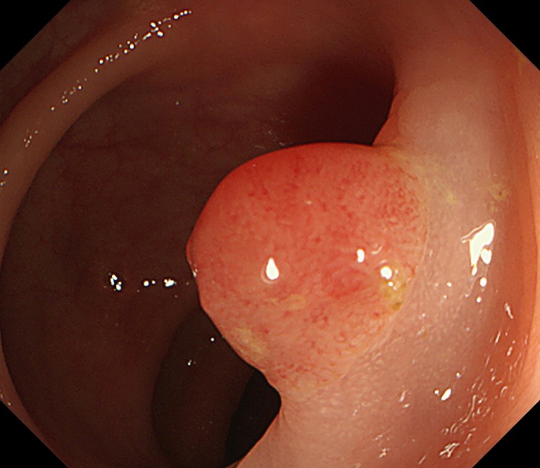 大腸ポリープ