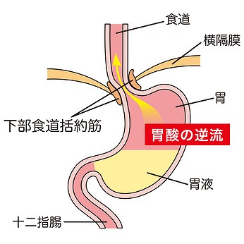 逆流性胃腸炎