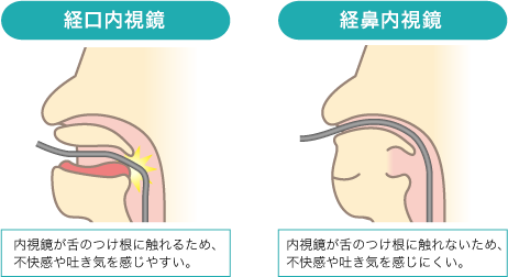 経鼻内視鏡と経口内視鏡との違いについて