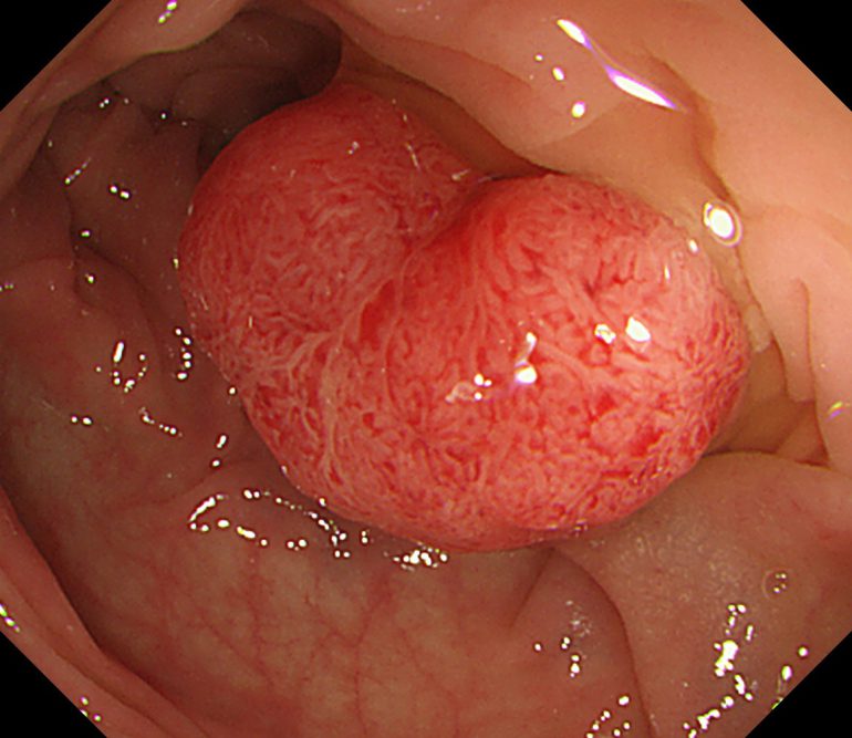 ポリープ 切除 大腸